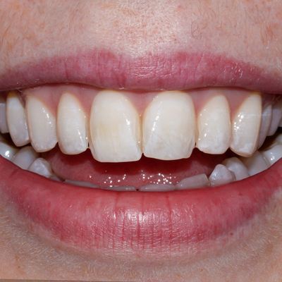 Composite Bonding - Smile 25 before